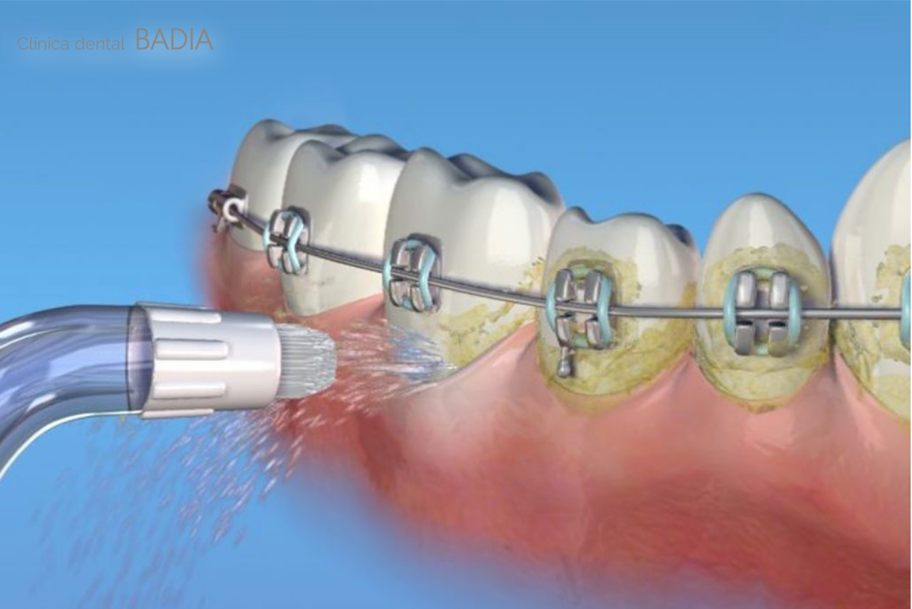 CEPILLADO E IRRIGACION BUCAL UN DUO IMPRESCINDIBLE EN PACIENTES CON ORTODONCIA Clinica dental Badia