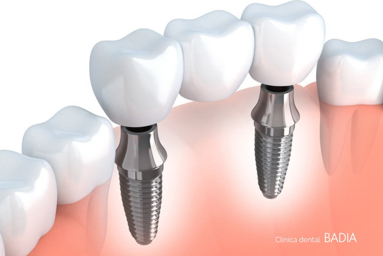 implantes-o-puentes