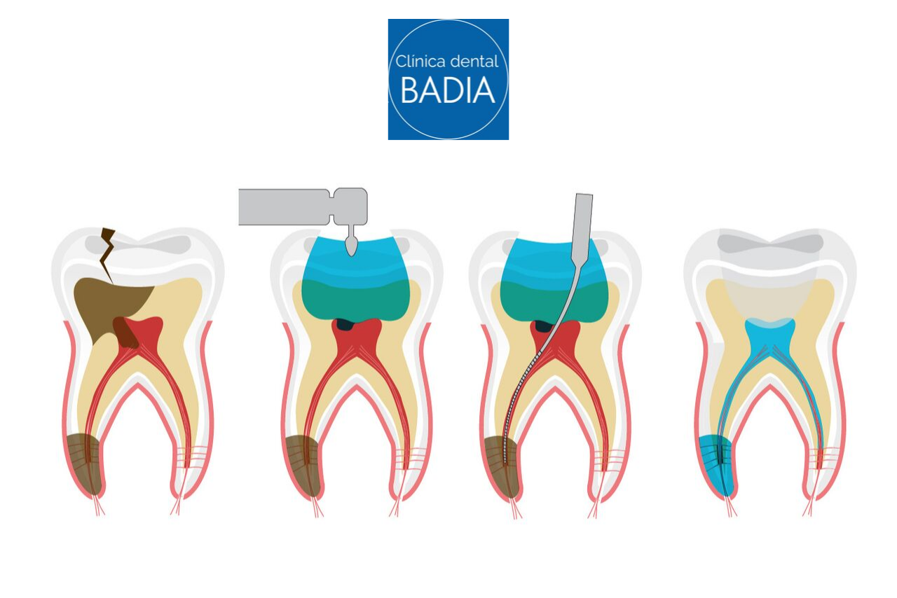 endodoncia-preguntas