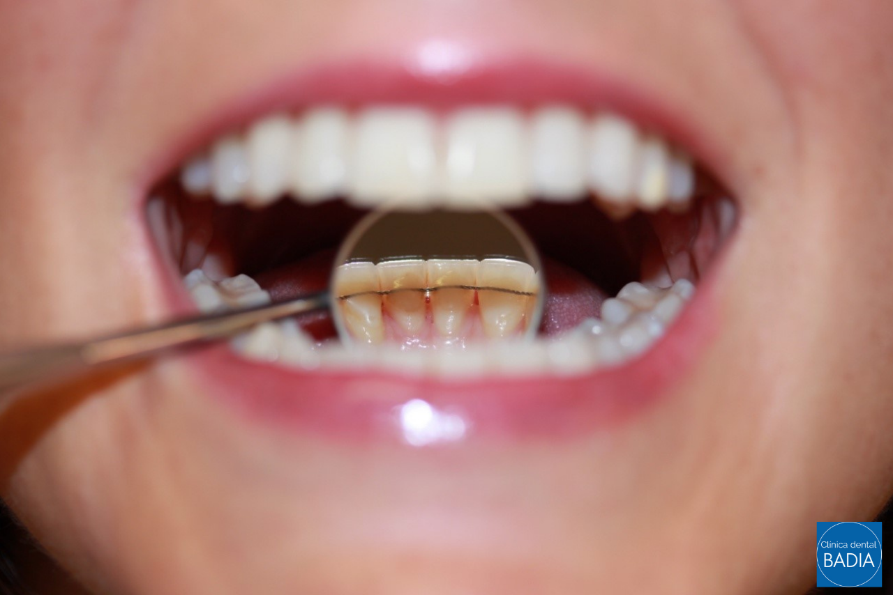 retenedores-dentales-tipos-duracion