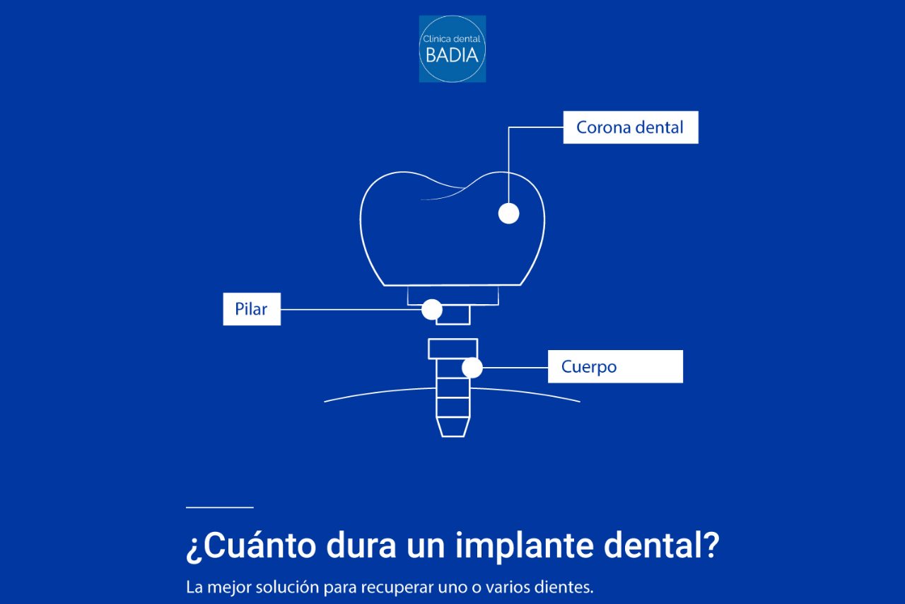 duracion-implante-dental