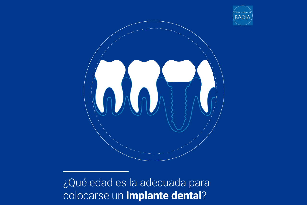 edad-adecuada-implante-dental