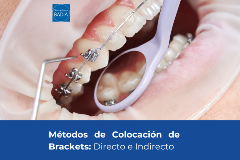 Colocación Brackets