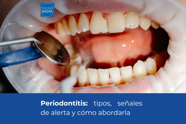 Periodontitis: tipos, señales de alerta y cómo abordarla