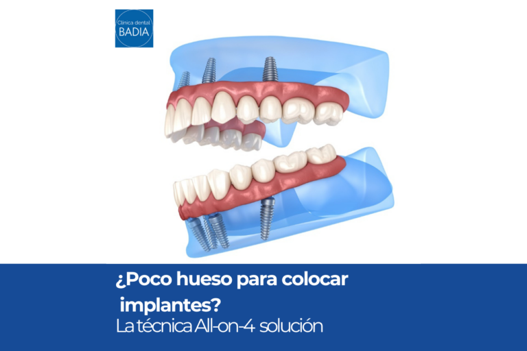 La técnica All-on-4 puede ser la solución