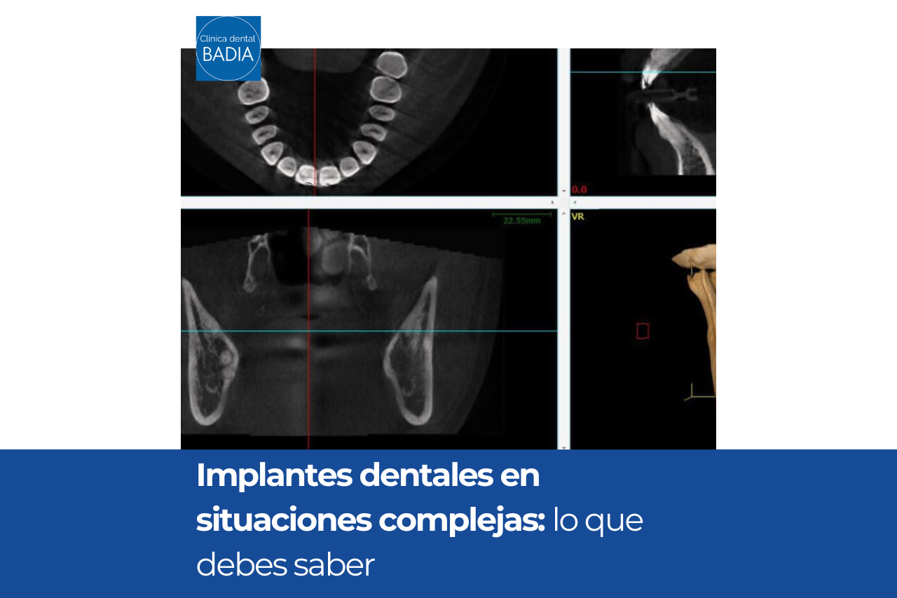 Implantes dentales en situaciones complejas: lo que debes saber